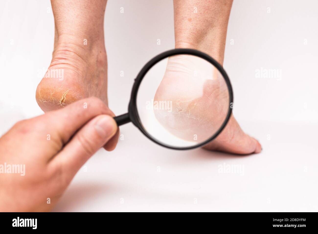 Closeup donna tacchi altamente asciutto su uno sfondo bianco attraverso una lente d'ingrandimento.la mano dei medici verifica quanto è incrinato la pelle. Foto Stock