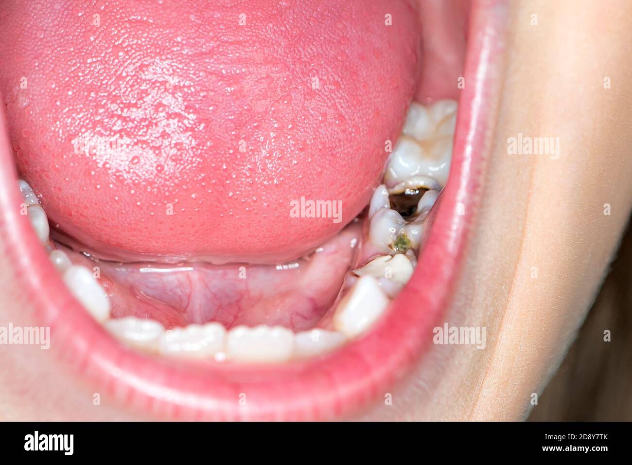 Carie precoci e denti decadenti. Il concetto di cura della cavità orale. Primo piano macrofotografia dell'interno della bocca e dei riempimenti Foto Stock