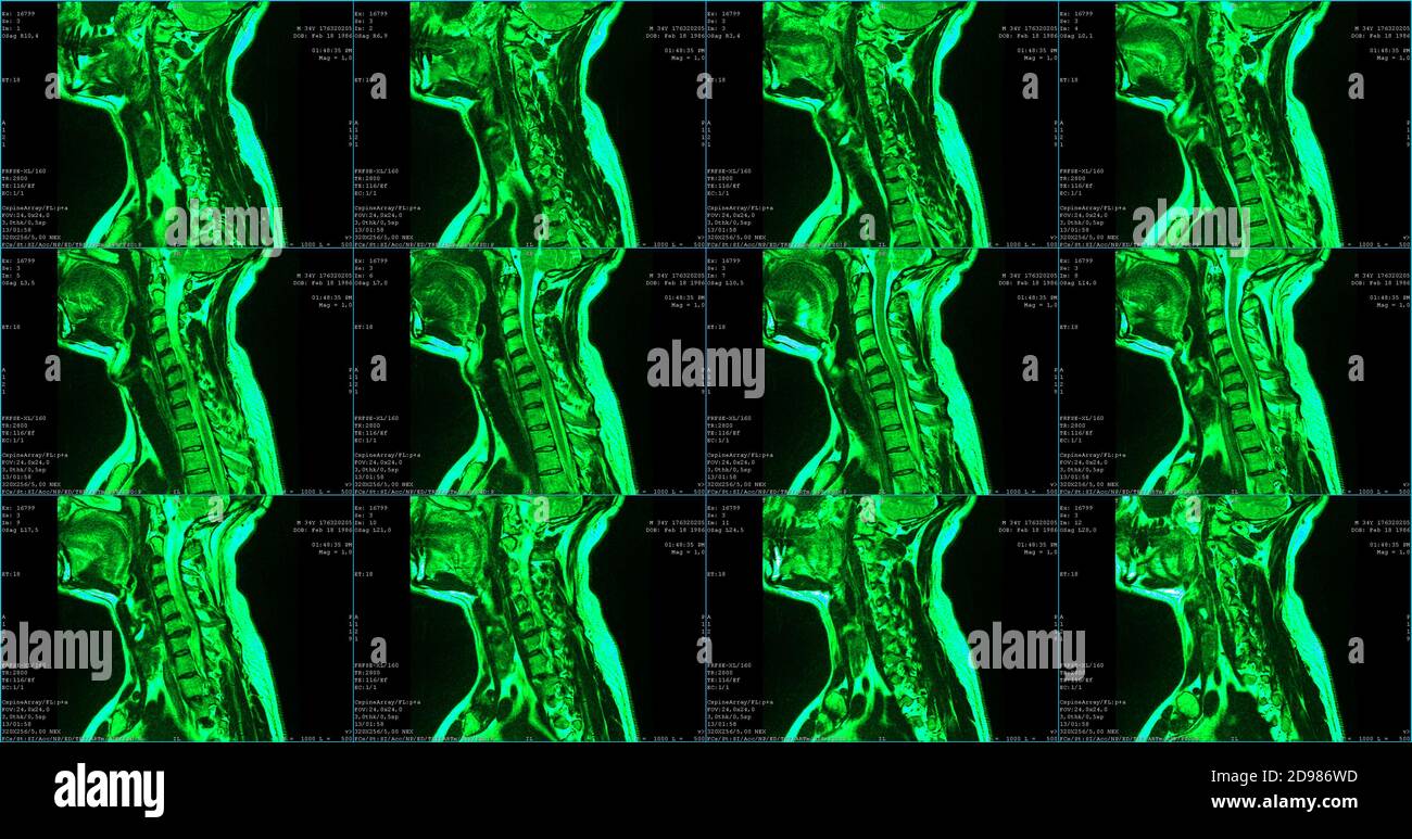 Set di 6 scansioni RM sagittali di colore verde del collo area di caucasico 34 anni maschio con paramediale bilaterale Estrusione del segmento C6-C7 Foto Stock