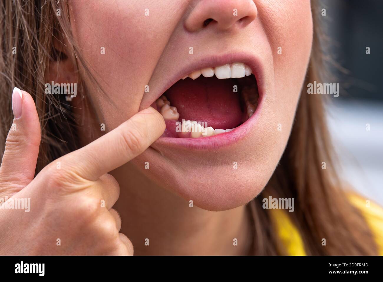 Giovane donna senza dente sulla mascella inferiore. Dente mancante. In attesa di un impianto dopo l'estrazione del dente Foto Stock