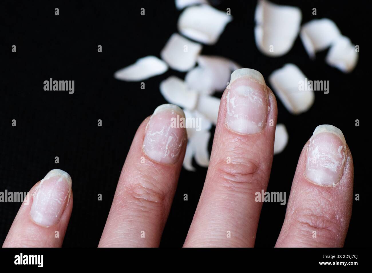 Primo piano di unghie fragili. Danni al chiodo dopo l'uso di gommalacca o  gel lucidante. Chiodi e gommalacca rotti Foto stock - Alamy