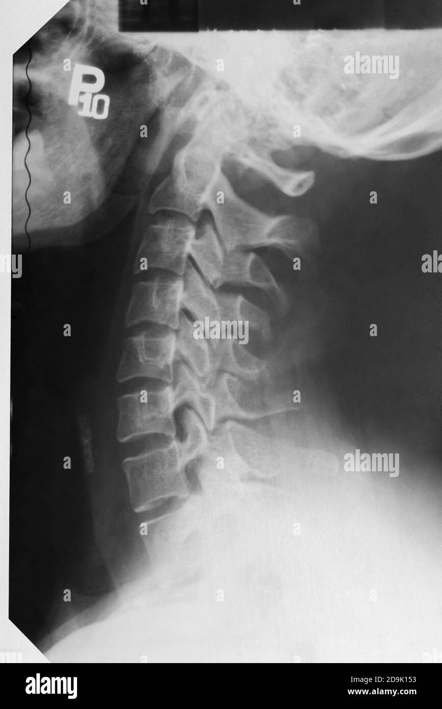 Donna adulta, immagine radiologica della colonna vertebrale del collo. Malattia della scansione della colonna vertebrale. Foto Stock