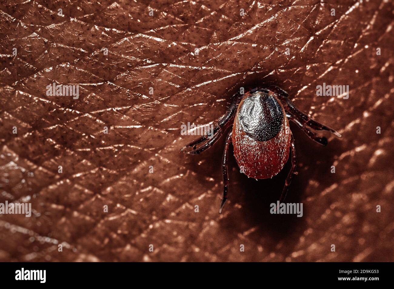 Succhiare da vicino gli acari sulle persone con pelle scura. Ixodes ricinus. Il parassita gonfiato si morso in epidermide rosa irritata. Piccole gocce rosse. Insetto pericoloso Foto Stock