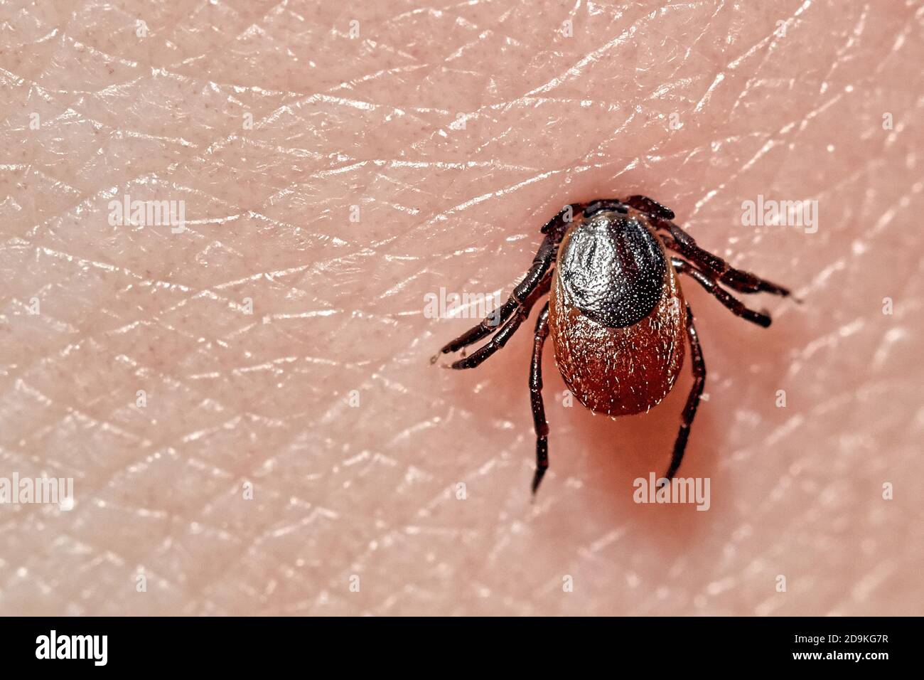 Succhiare la foto macro di spunta sulla pelle umana. Ixodes ricinus. Il parassita gonfiato si morso in epidermide rosa irritata. Piccole gocce rosse. Pericoloso acaro di insetto Foto Stock