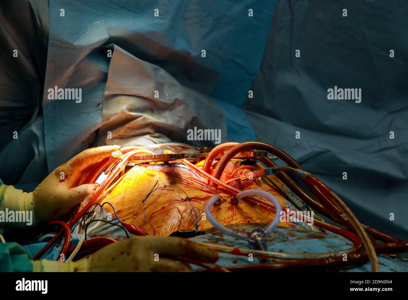 Battere il cuore umano nel petto aperto durante l'intervento chirurgico durante la chirurgia cardiaca Foto Stock
