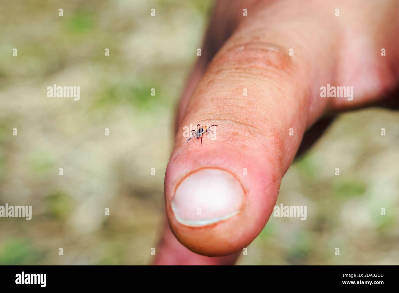 Acaro duro, graduazione della famiglia Ixodidae sul dito umano. Porta di patogeni che possono causare malattie umane. Foto Stock
