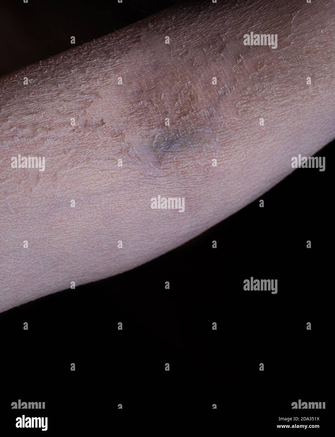 Vista ritagliata di un braccio femminile con pelle esfoliata morta isolata su sfondo nero. Effetti collaterali del trattamento medico. Foto Stock