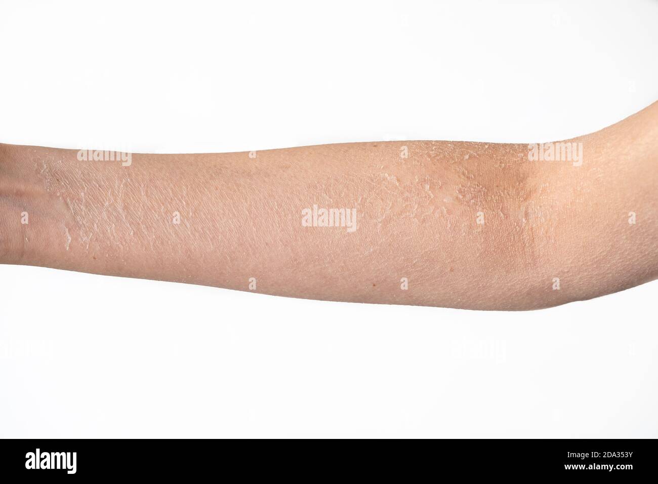 Vista ritagliata di un braccio femminile con pelle esfoliata morta isolata su sfondo bianco. Effetti collaterali del trattamento medico. Foto Stock