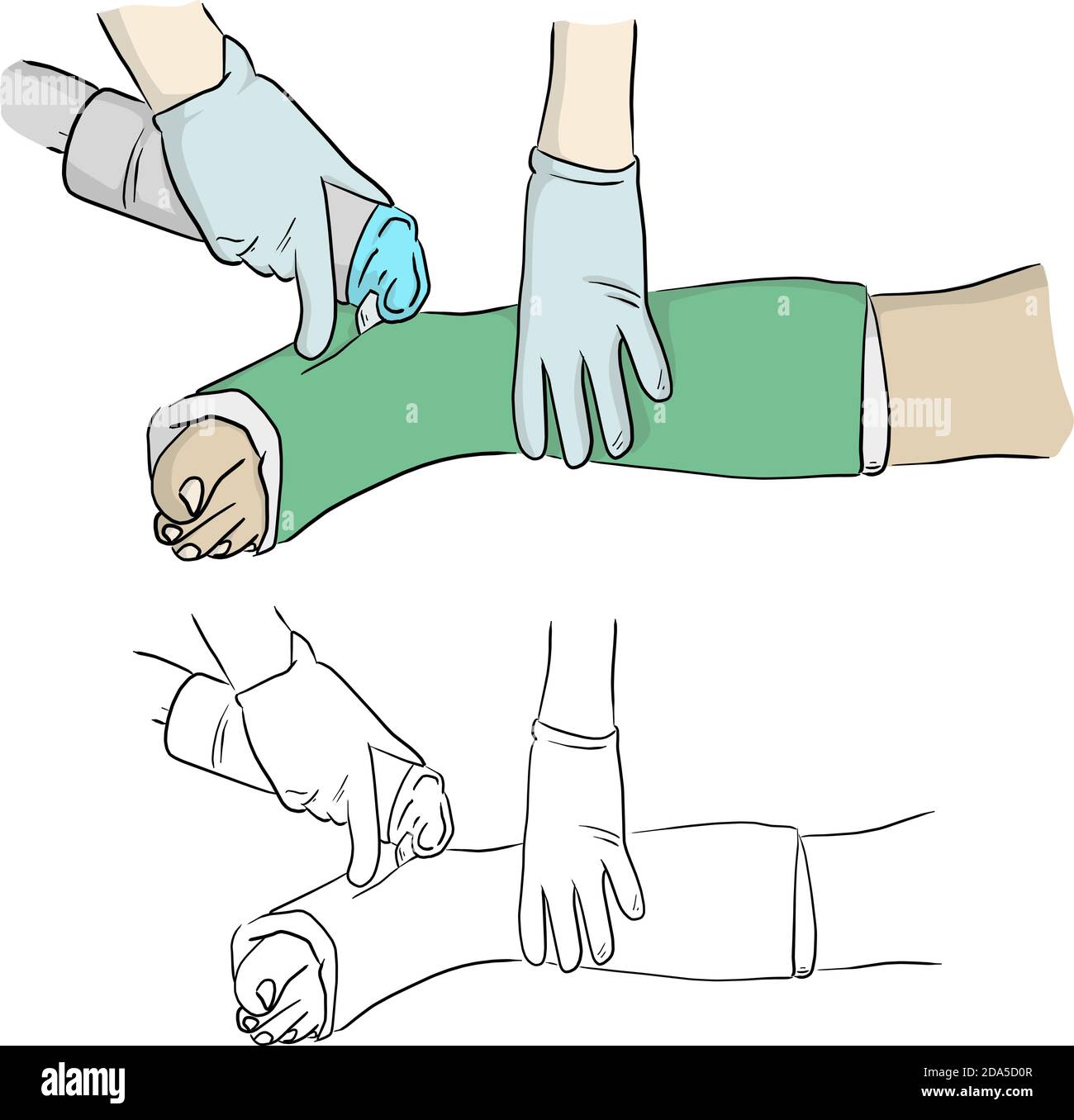 primo piano taglio manuale gesso colato a gamba e piede paziente per immobilizzare dopo la lesione da frattura illustrazione vettoriale schizzo mano a dodle disegnato con nero Illustrazione Vettoriale