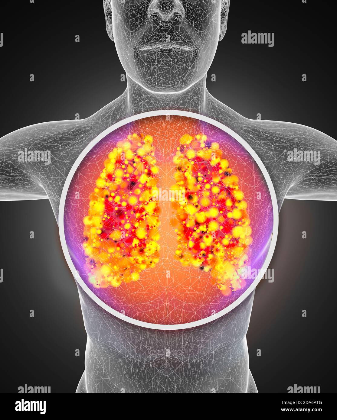 Anatomia umana, problemi con il sistema respiratorio, polmoni gravemente danneggiati. Polmonite bilaterale. Covid-19, coronavirus. Paziente e fumo. Fumatore. 3d Foto Stock