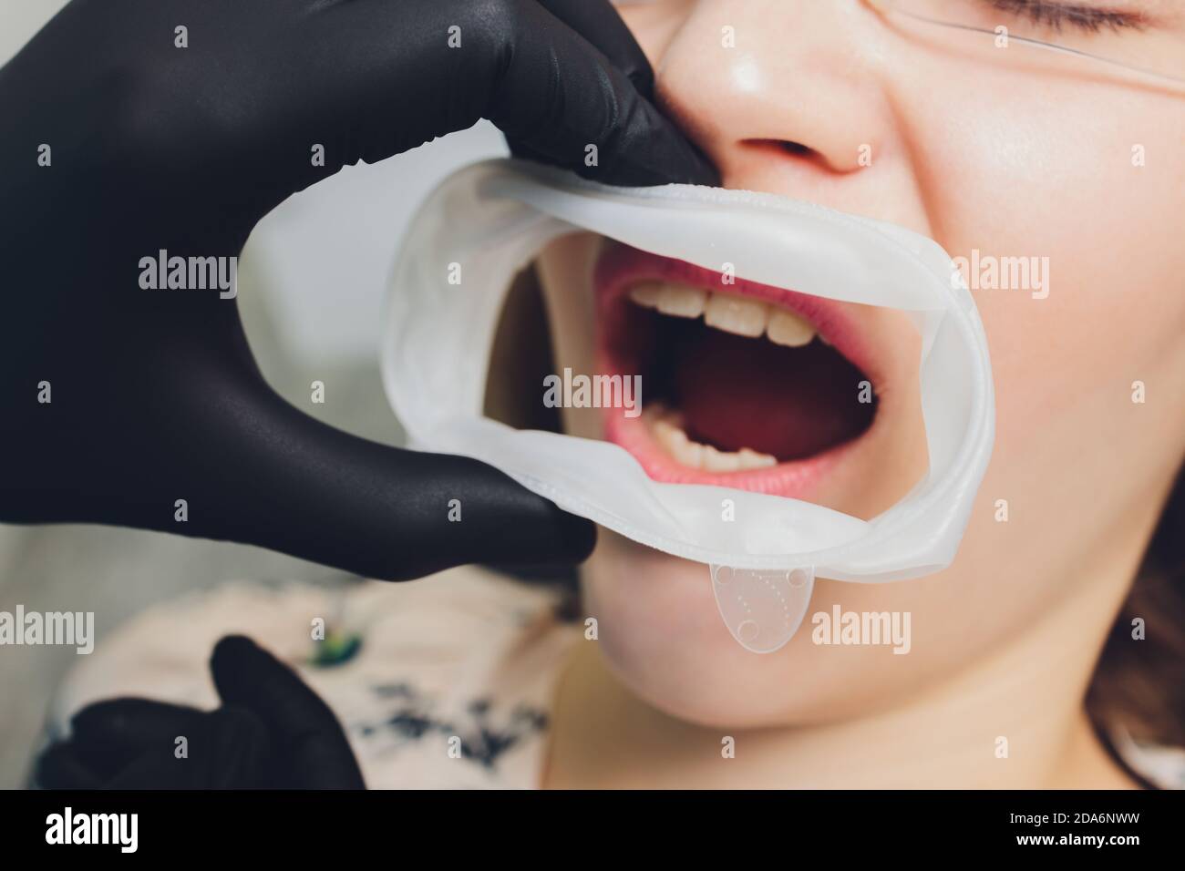 Foto in primo piano di una diga monouso in gomma per denti utilizzata per mantenere i tessuti molli della bocca al sicuro dagli utensili dentali. Foto Stock