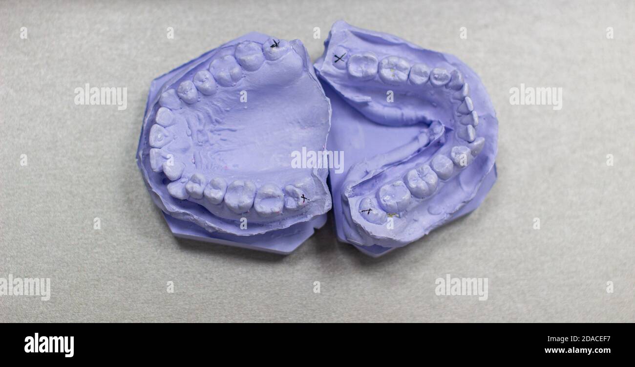 Calco di intonaco dei denti da intonaco all'ortodontista. Foto Stock