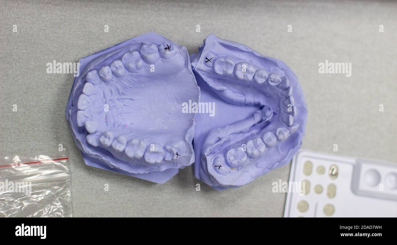 Calco di intonaco dei denti da intonaco all'ortodontista. Foto Stock