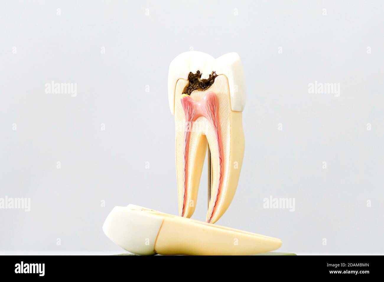 Modello di decadimento dei denti. Foto Stock
