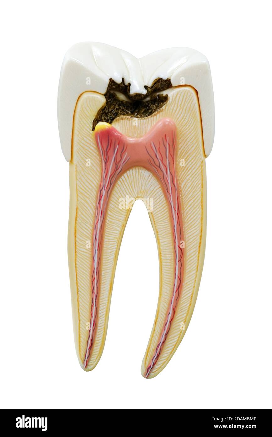 Modello di decadimento dei denti. Foto Stock