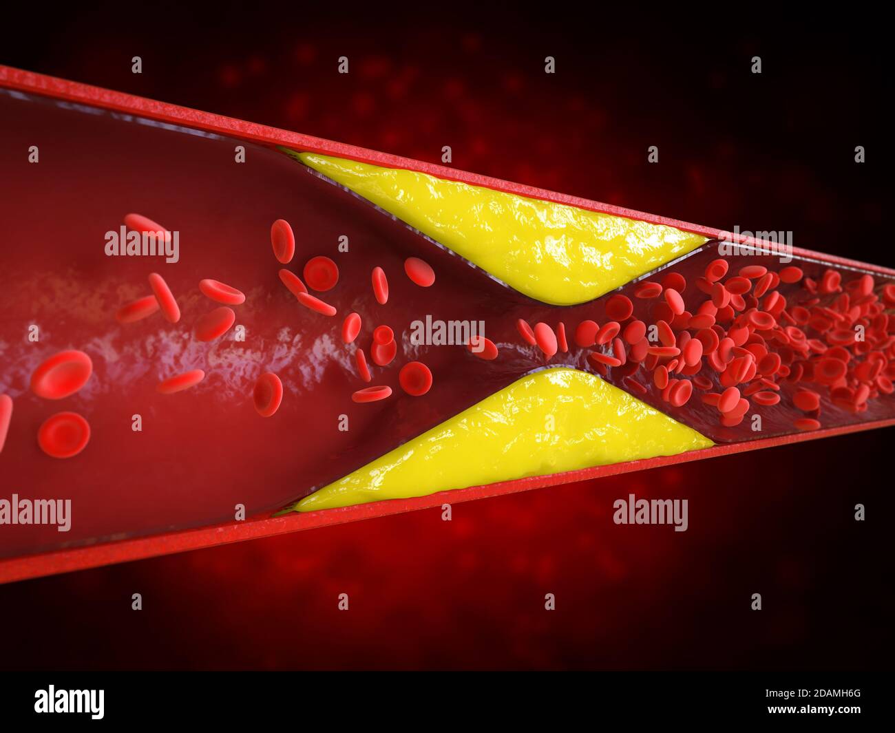 aterosclerosi 3d con sangue di colesterolo o placca nel vaso causa della coronaropatia Foto Stock