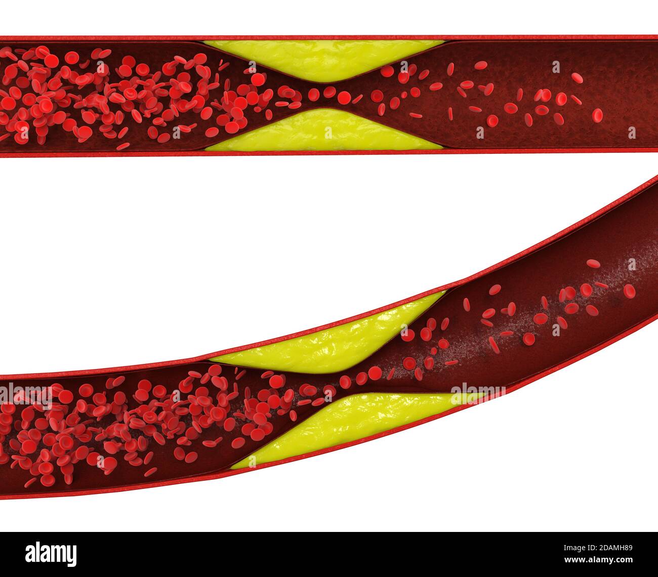 aterosclerosi 3d con sangue di colesterolo o placca nel vaso causa della coronaropatia Foto Stock