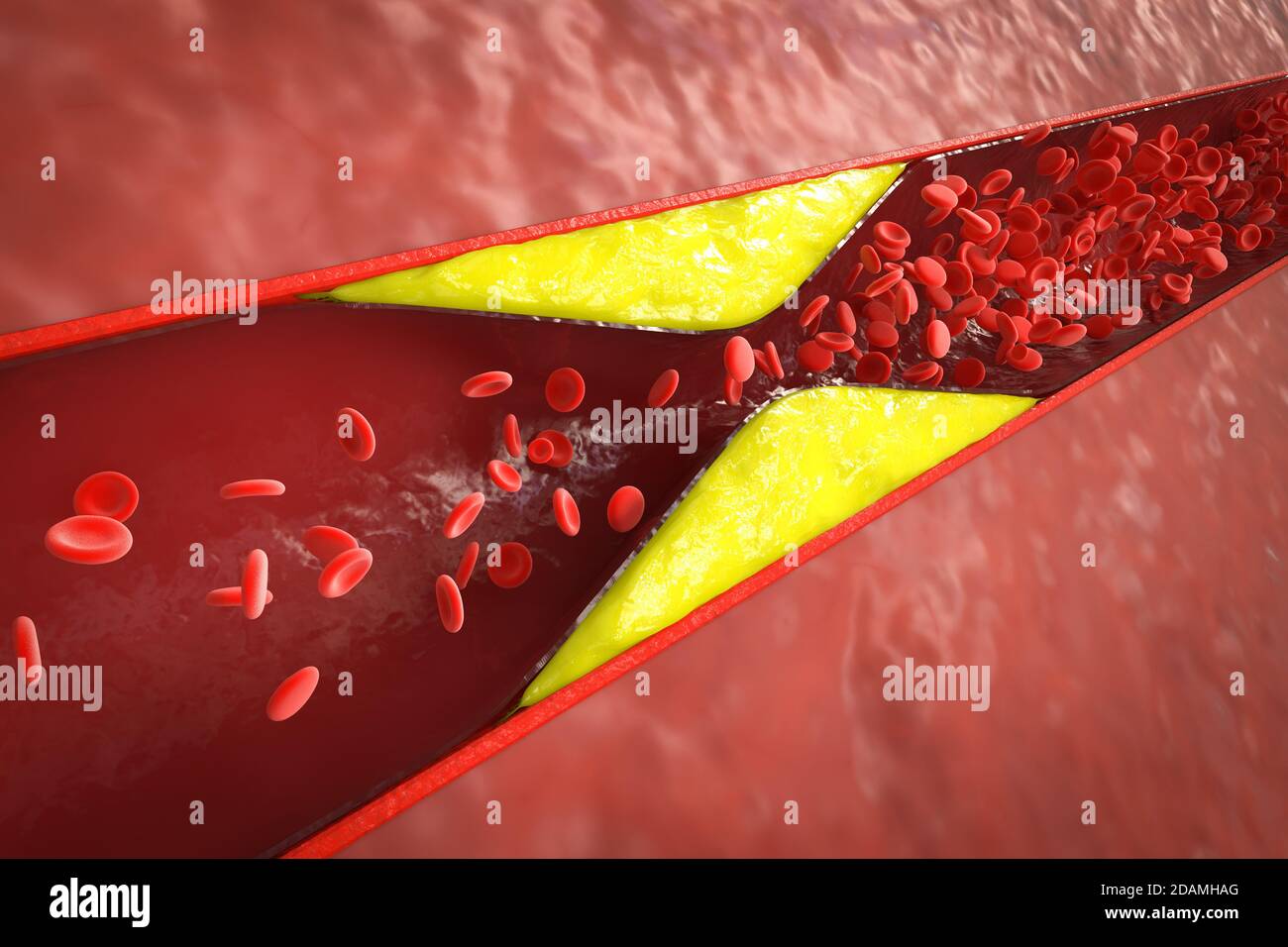 aterosclerosi 3d con sangue di colesterolo o placca nel vaso causa della coronaropatia Foto Stock