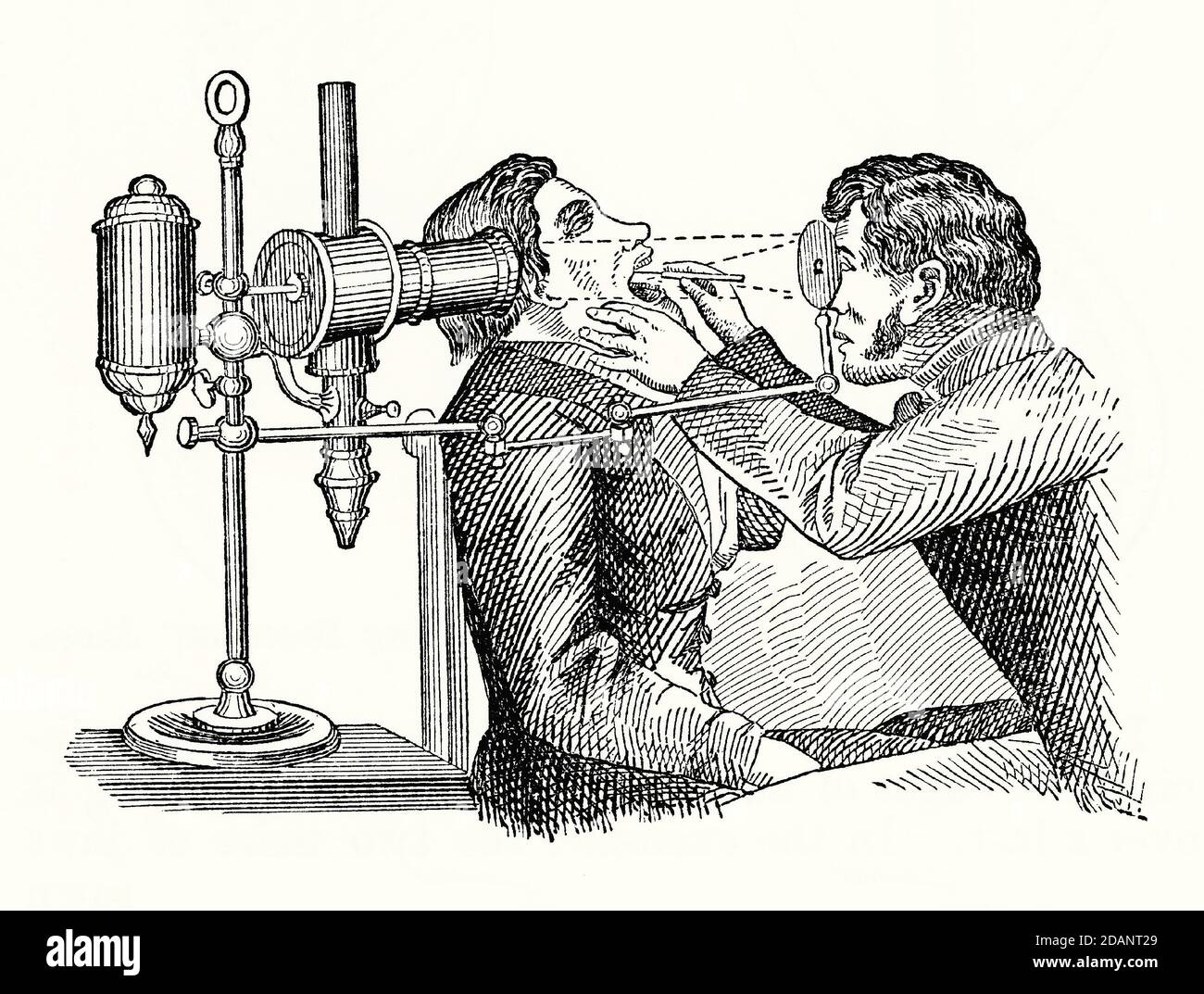Una vecchia incisione di un paziente che ha la sua laringe esaminata da un medico usando un laringoscopio. E 'da un libro di meccanica vittoriana del 1880. Laryngoscopy è endoscopia della laringe, parte della gola per vedere le pieghe vocali e la glottite. Molte versioni dell'apparecchio furono inventate nel 1800. Quello illustrato è un laringoscopio Tieman. Una sorgente di luce artificiale (sinistra) brilla sullo specchio concavo che il medico tiene e viene riflessa verso il basso sulla bocca del paziente su uno specchio più piccolo all'estremità dello strumento inserito nella bocca, illuminando l'area per l'ispezione. Foto Stock