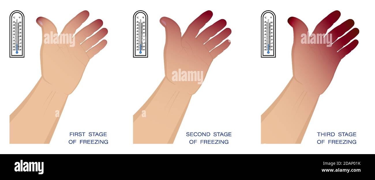 mano dell'uomo con diverse fasi di congelamento. Congelamento e danni alla  pelle in inverno in aria fredda. Primo soccorso per l'ipotermia. Vettore  Immagine e Vettoriale - Alamy