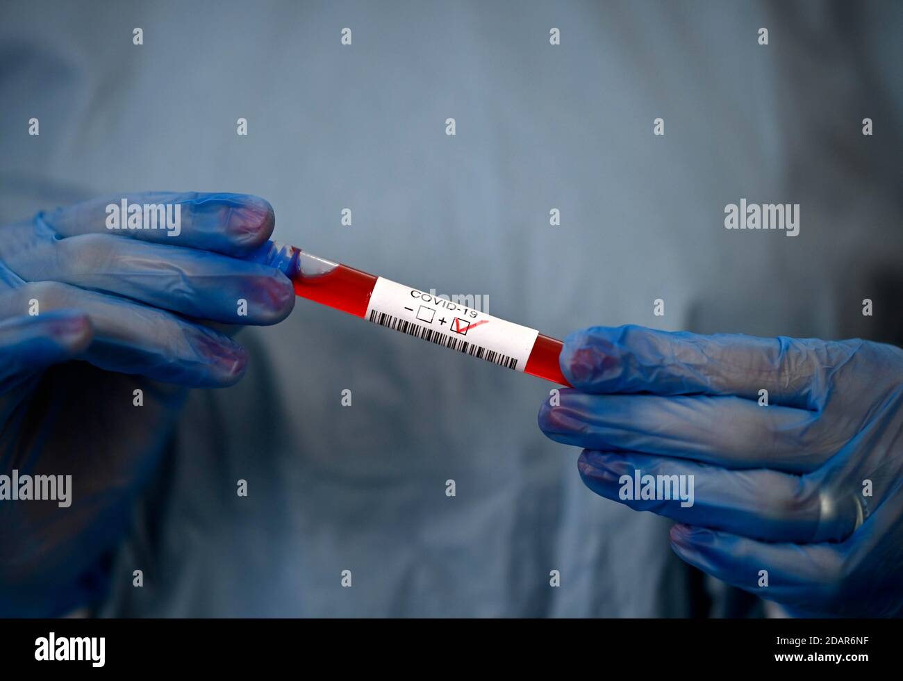 Risultato positivo del test, personale medico che utilizza RT-PCR, reazione a catena della polimerasi a trascrittasi inversa in tempo reale, test corona, crisi corona Foto Stock