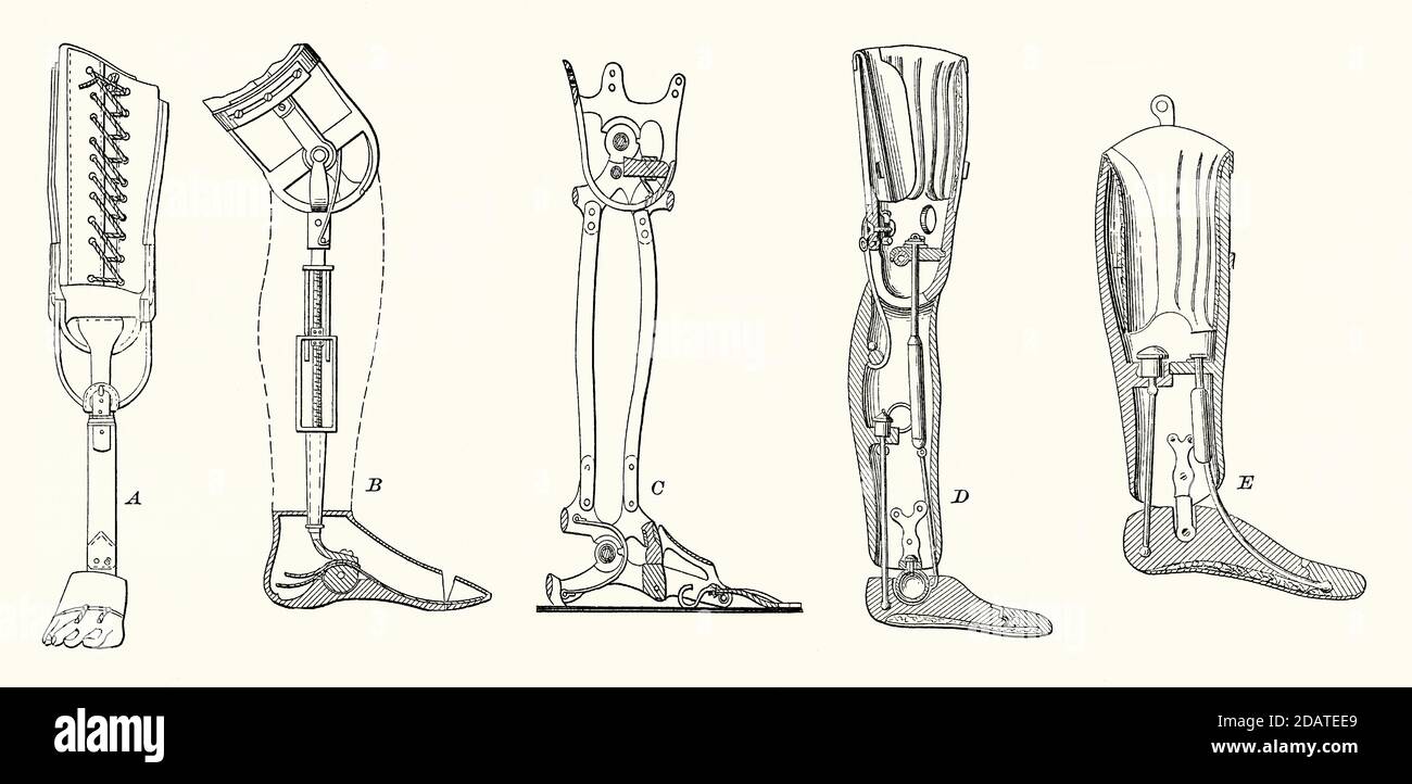 Una vecchia incisione delle varie gambe protesiche utilizzate nel 1800. E 'da un libro di ingegneria meccanica vittoriana del 1880. Londoner James Potts inventò una protesi sopra il ginocchio nel 1800 con un polpaccio e una coscia in legno, e un piede flessibile. Le illustrazioni mostrano le protesi di diversa progettazione utilizzate per facilitare la camminata. D ed e illustrano protesi con un attacco sferico in corrispondenza dell'articolazione della caviglia che consente una maggiore mobilità. Foto Stock