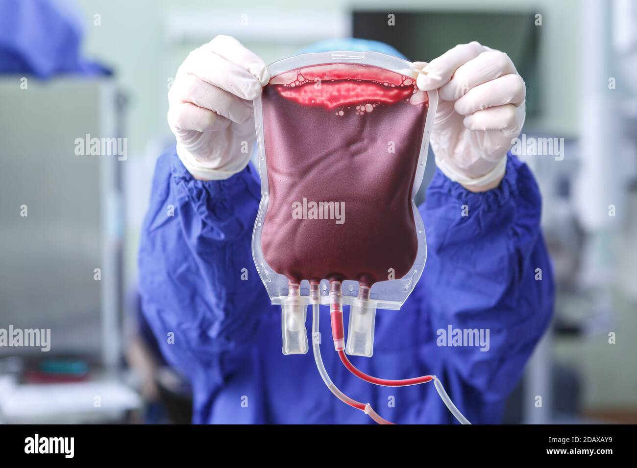 Mani guelse di un lavoratore medico che tiene una borsa di primo piano del sangue del donatore Foto Stock