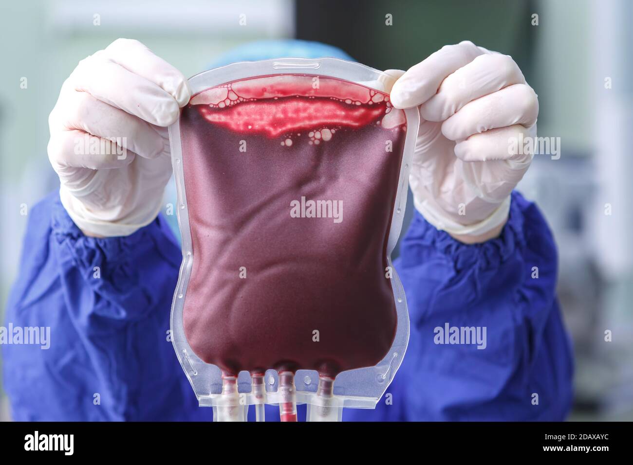 Mani guelse di un lavoratore medico che tiene una borsa di primo piano del sangue del donatore Foto Stock