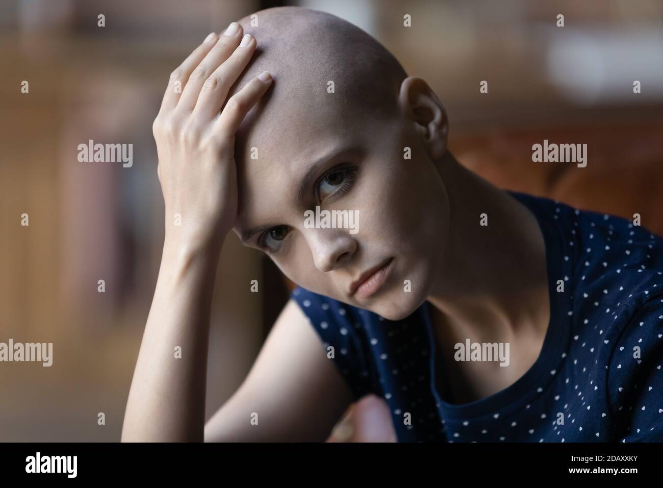 Donna millenaria sconvolta con diagnosi di cancro che tocca la testa senza peli Foto Stock