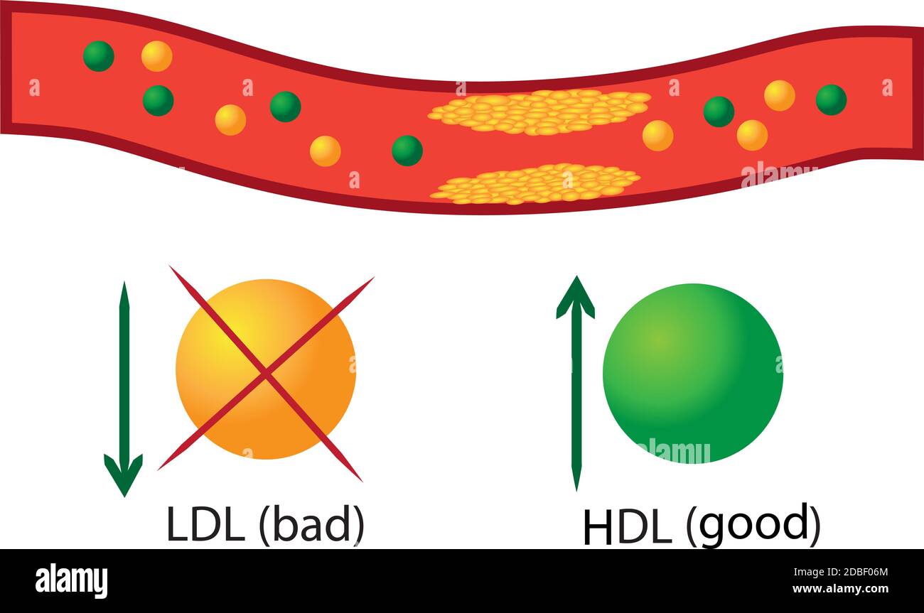 Placca aterosclerotica nei vasi sanguigni, lipidi buoni e cattivi la loro regolazione in infografiche dei vettori sanguigni Foto Stock