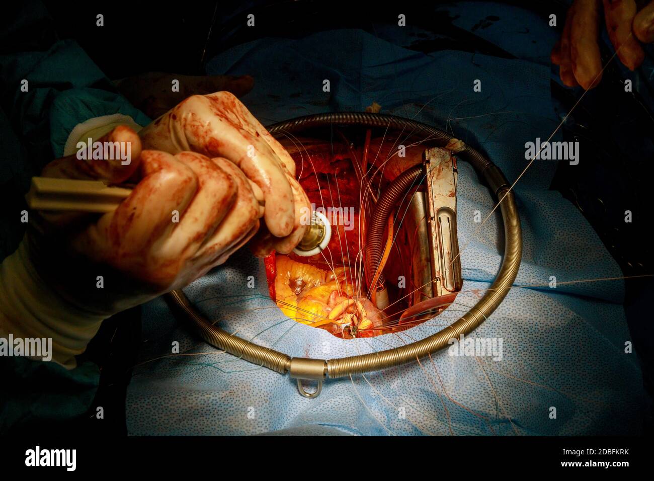 Il chirurgo sta mettendo i punti sull'impianto artificiale della valvola cardiaca della bioprotesi a cuore aperto Foto Stock