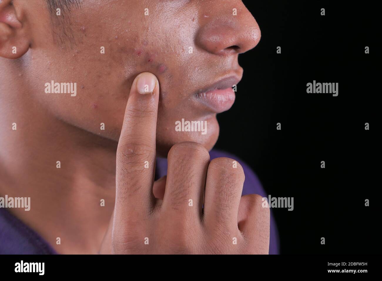 primo piano del viso del giovane uomo con problema di pelle . Foto Stock