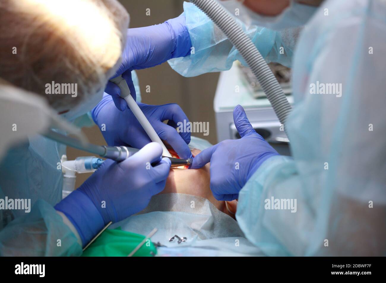 Mani del medico e dell'assistente durante l'operazione per rimuovere le carie profonde. Foto irriconoscibile. Funzionamento in anestesia generale. Spazio di copia. Foto Stock