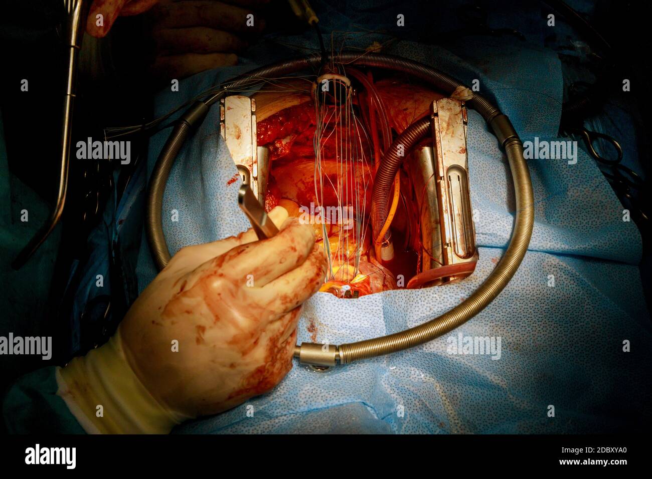 Intervento chirurgico a cuore aperto impianto aortico di sostituzione meccanica della valvola Foto Stock