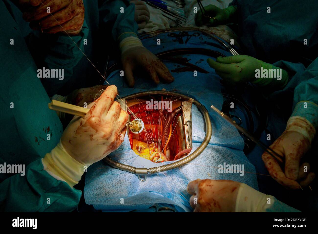 Intervento chirurgico di sostituzione della valvola aortica sul cuore umano finale chirurgico cuciture che fissano la protesi alla parete dell'aorta Foto Stock
