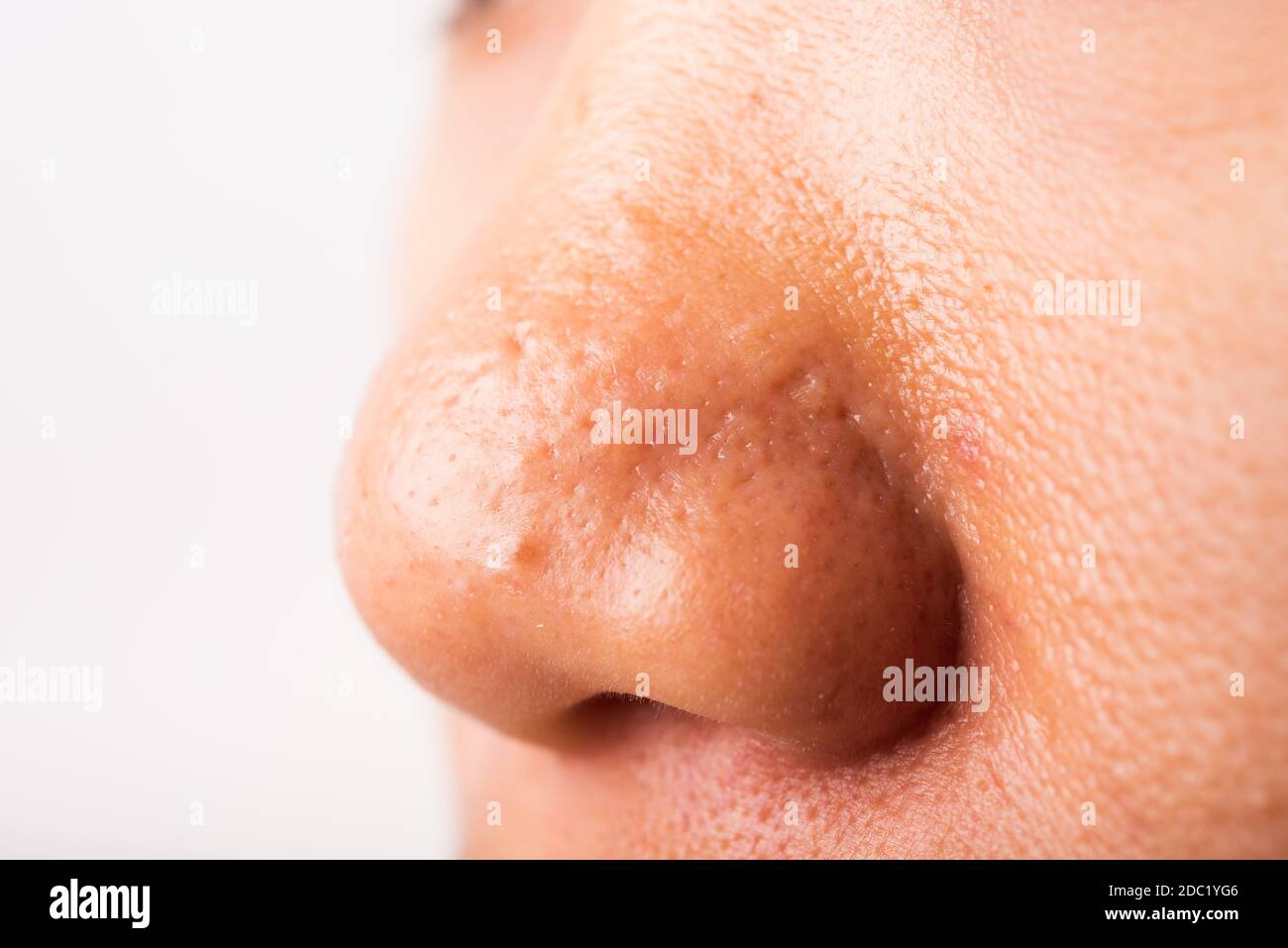 Closeup Asian giovane donna grandi pori hanno fleckles guancia oleosa, acne pimple sul naso, studio girato isolato su sfondo bianco, Healthcare bellezza pelle Foto Stock