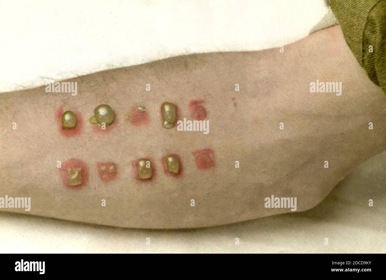 Bolle di gas senape, prima guerra mondiale Foto Stock