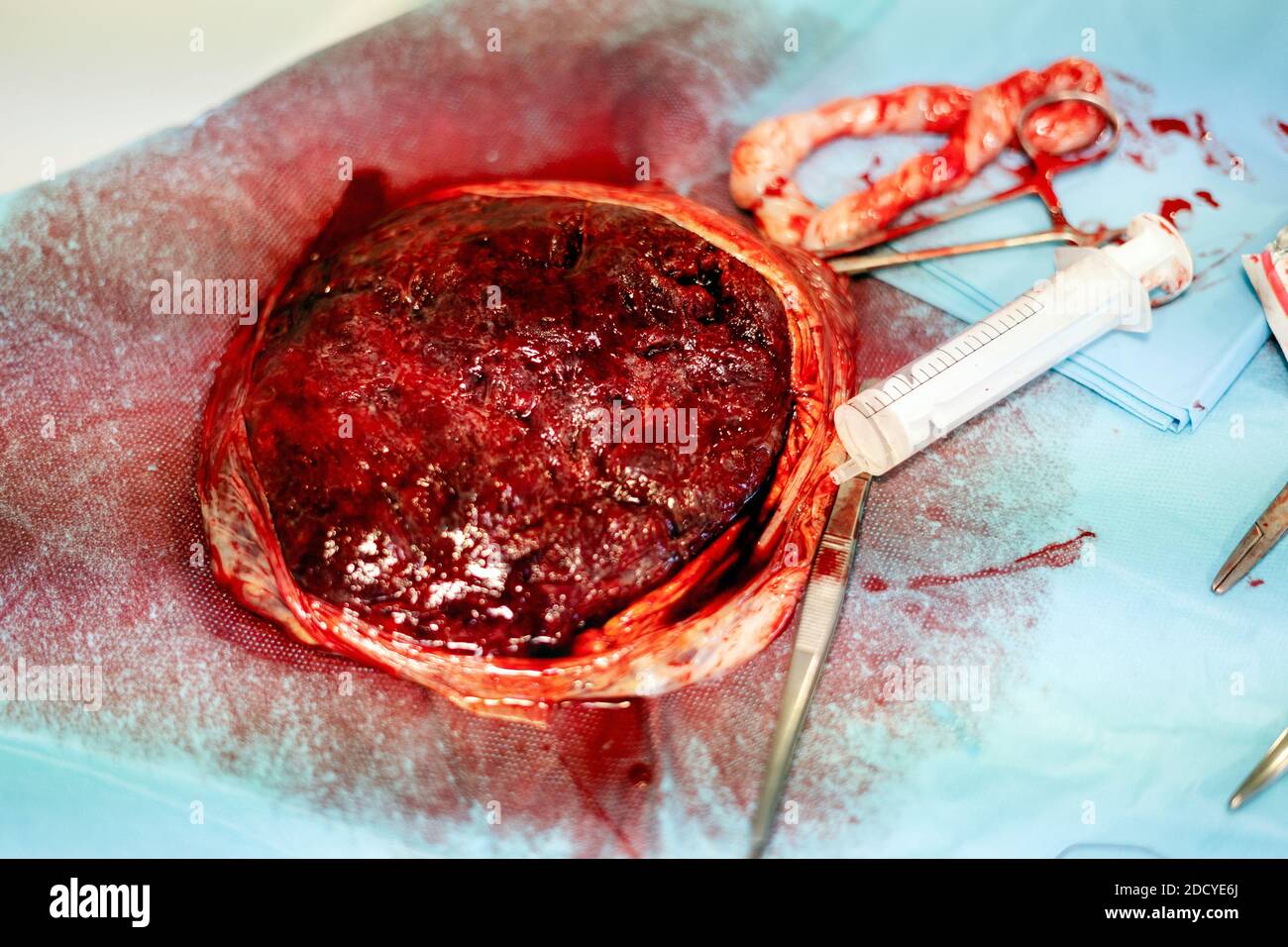 Placenta umana subito dopo il parto Foto Stock