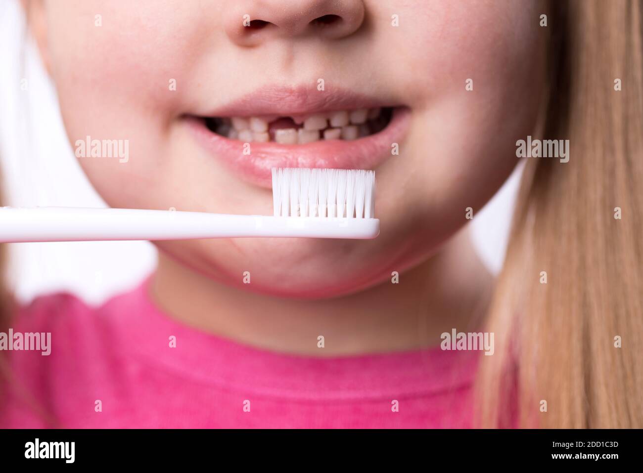 Ragazza prescolare con i primi incisivi adulti e uno spazzolino da denti. Il dente del latte è caduto fuori e un dente permanente cresce in bocca aperta. Dentale Foto Stock