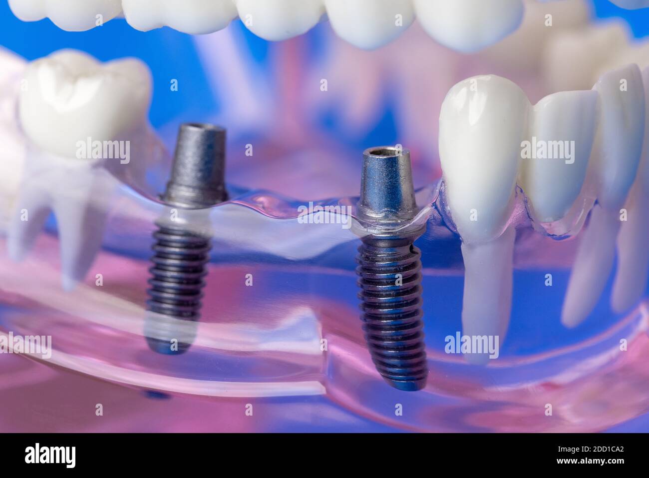 viti a ponte per impianti dentali nel modello a denti di mascella umani Foto Stock