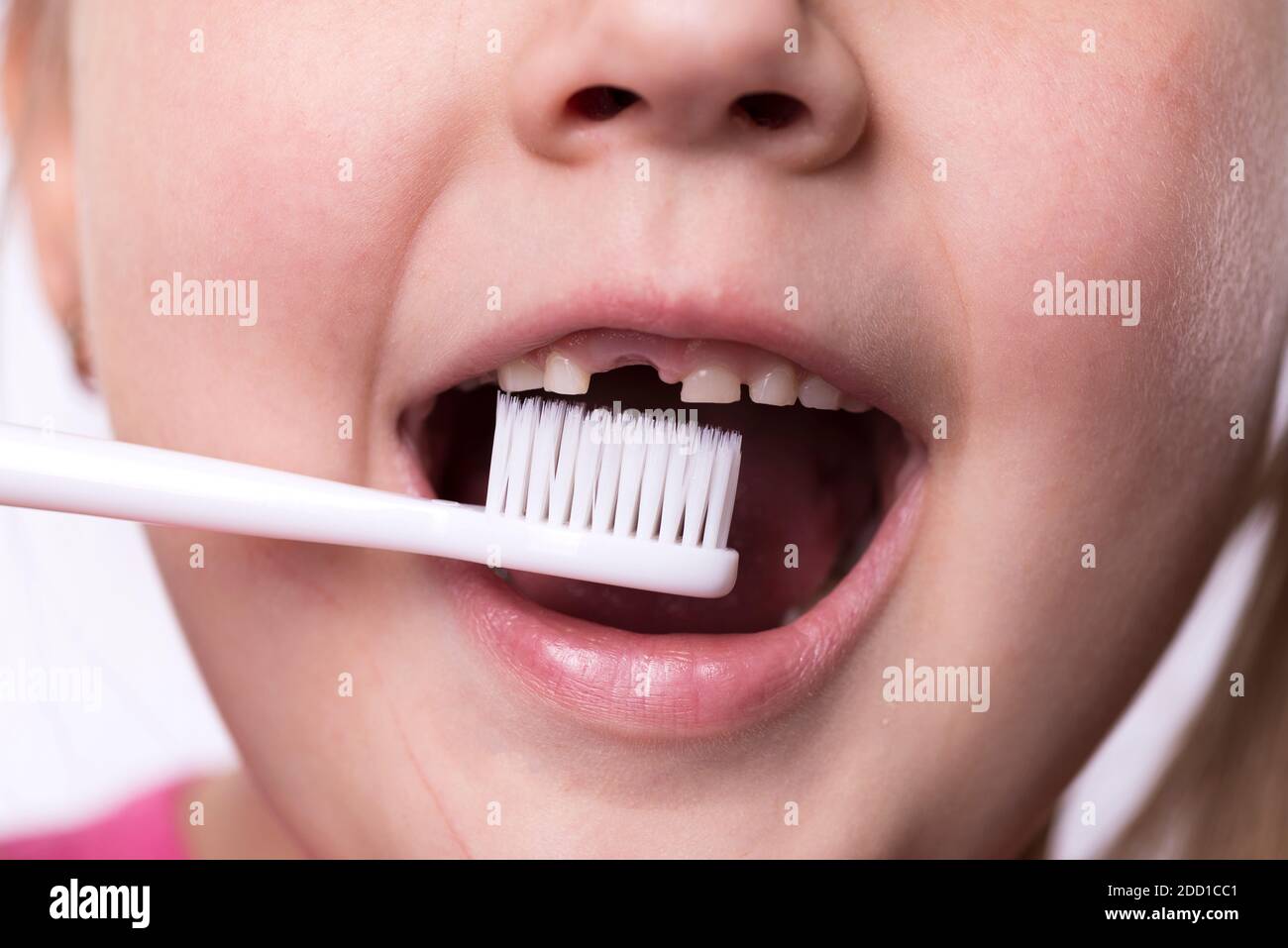 Ragazza prescolare con i primi incisivi adulti e uno spazzolino da denti. Il dente del latte è caduto fuori e un dente permanente cresce in bocca aperta. Dentale Foto Stock