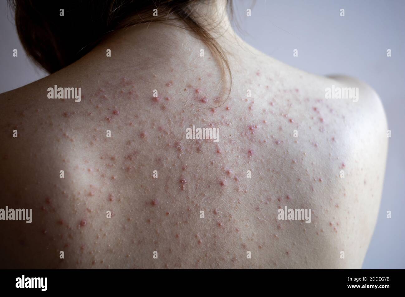 donna indietro con acne, macchie rosse, malattia della pelle Foto stock -  Alamy
