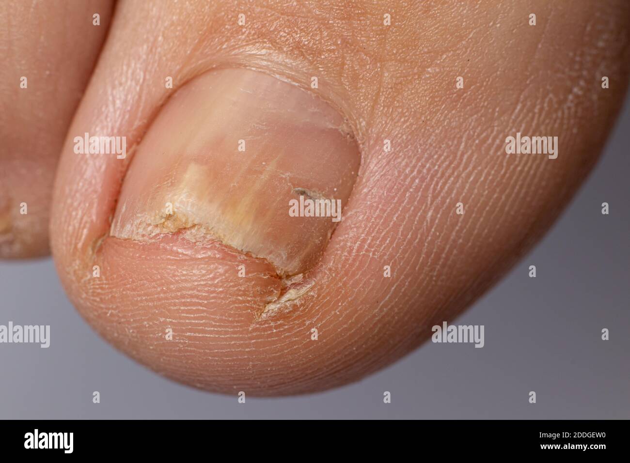 Fungo di unghie sul piede grande - dermatomicosi e onicosi, infezione fungina macro foto. Foto Stock