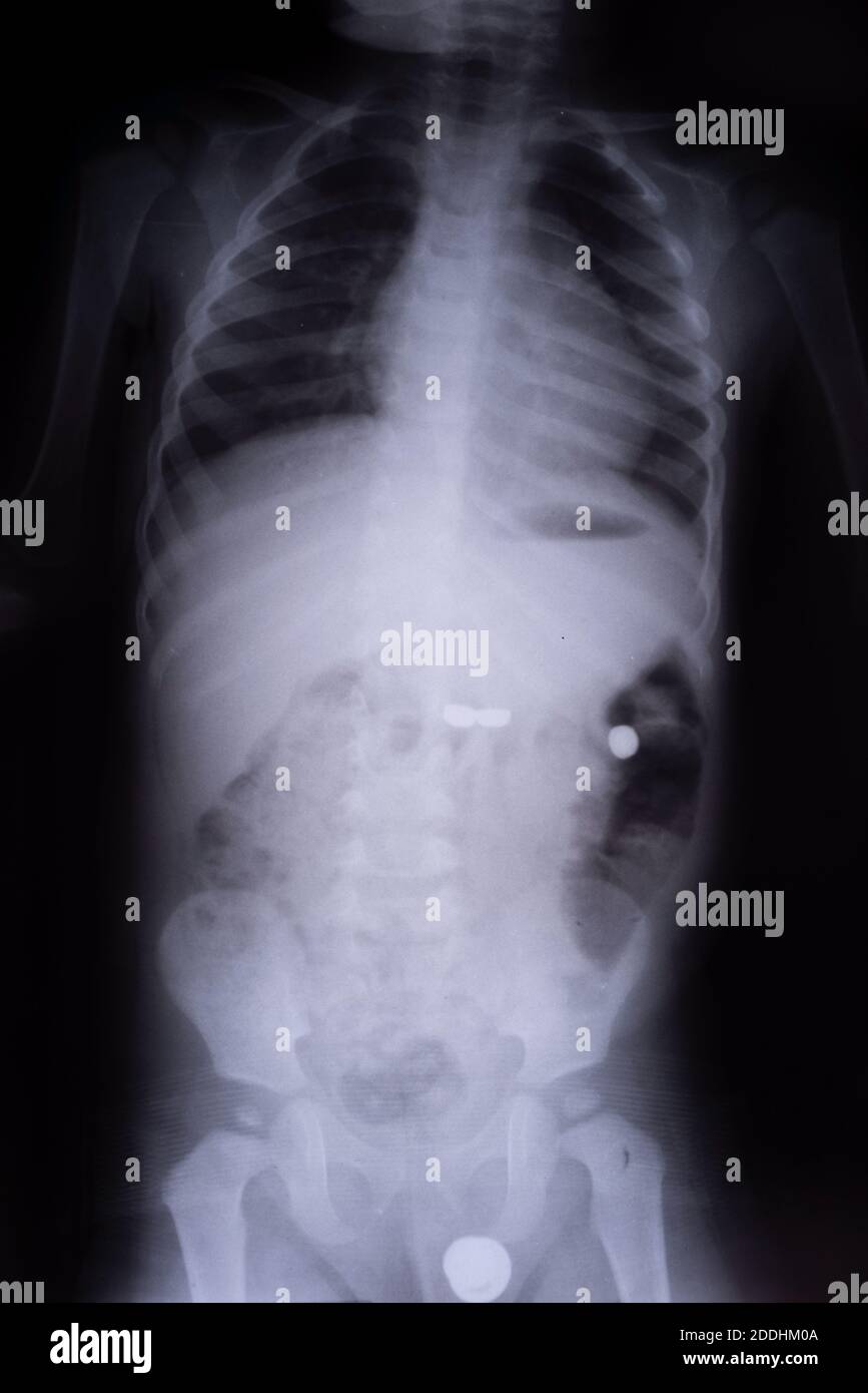 Raggi X di un bambino con una batteria corpo estranea nel tratto gastrointestinale raggi X, monete trovato nello stomaco di un bambino di 3 anni - bianco, nero Foto Stock