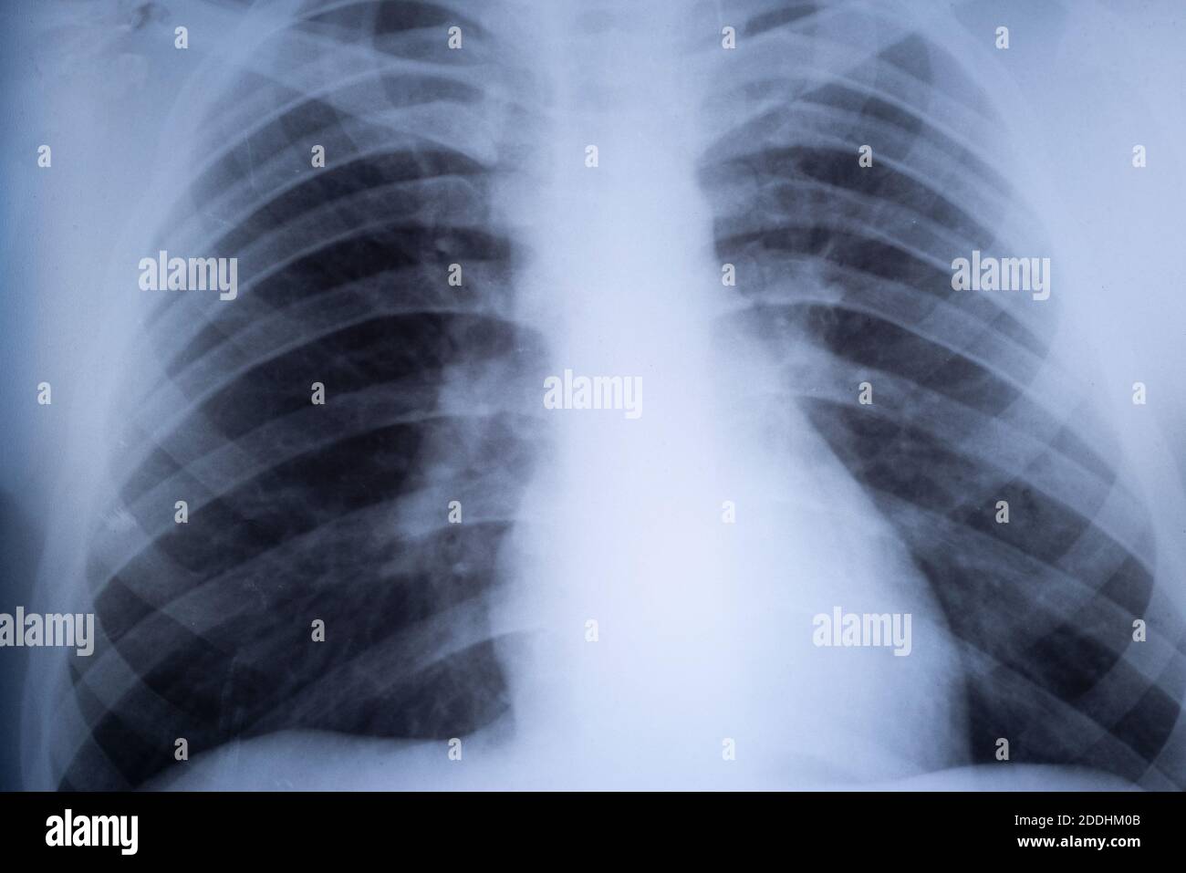 raggi x dei polmoni di un adolescente. Patologia polmonare. Radiografia frontale del torace di un bambino Foto Stock