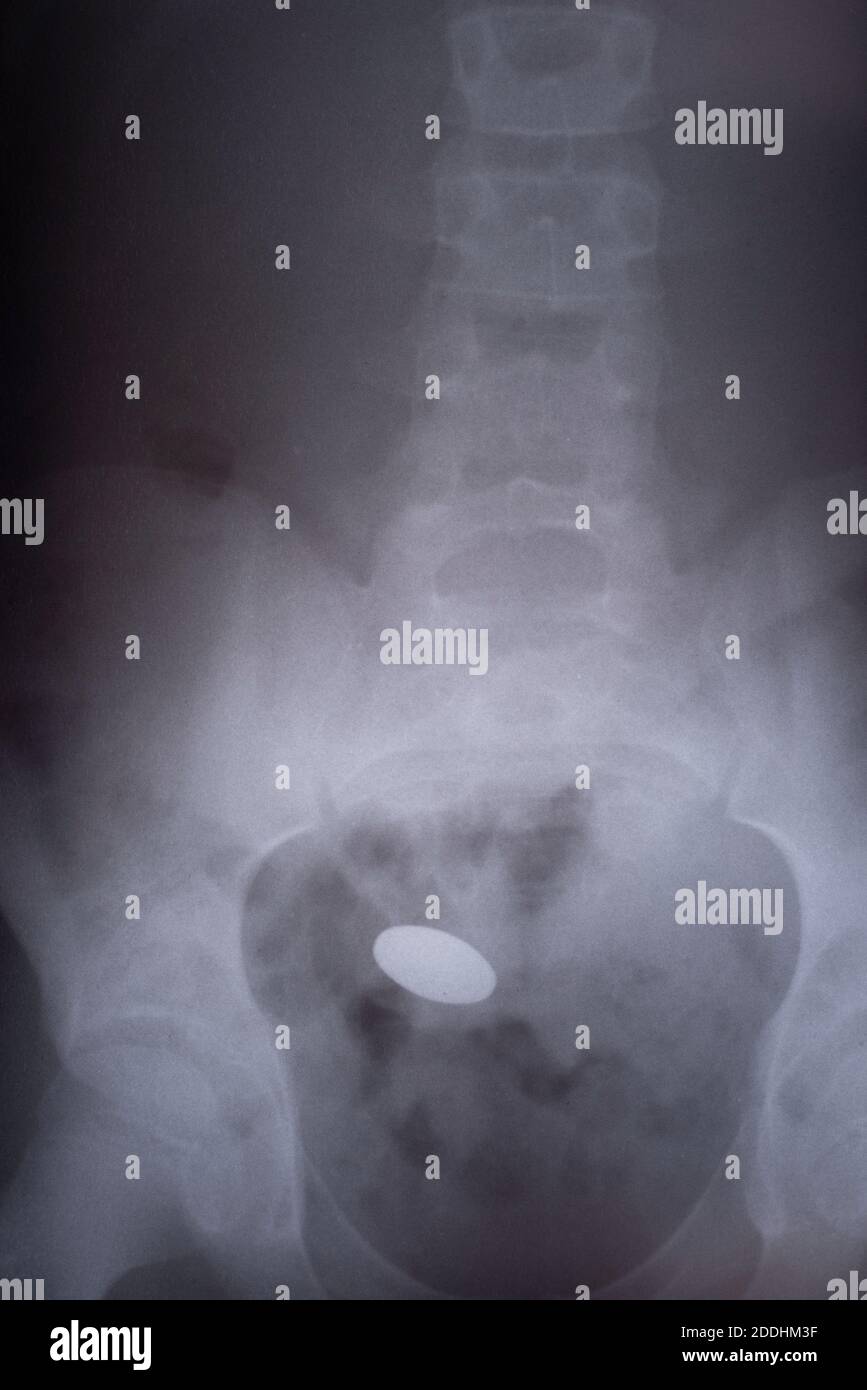 Raggi X di un bambino con una batteria corpo estranea nel tratto gastrointestinale raggi X, monete trovato nello stomaco di un bambino di 3 anni - bianco, nero Foto Stock