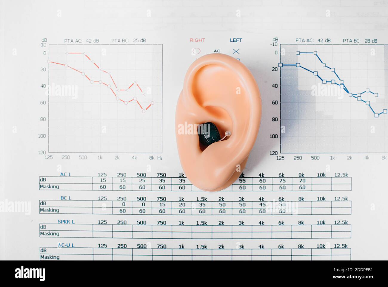 Audiometria, diagnosi di compromissione dell'udito. Primo piano dell'apparecchio acustico e del modello auricolare sullo sfondo dei risultati dei test uditivi Foto Stock