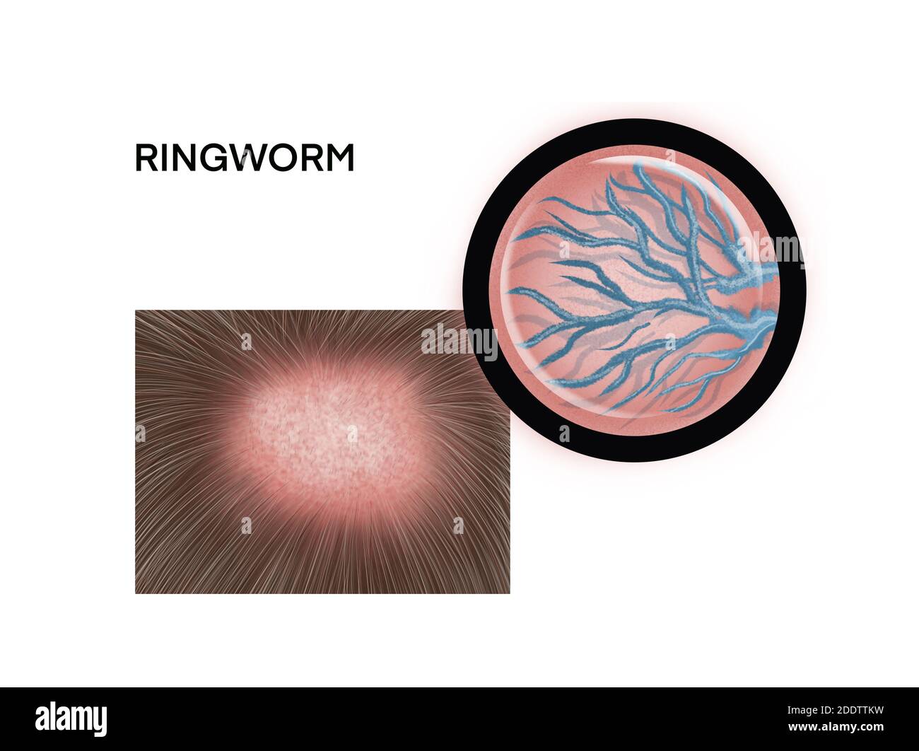 Illustrazione medica di Foto Stock
