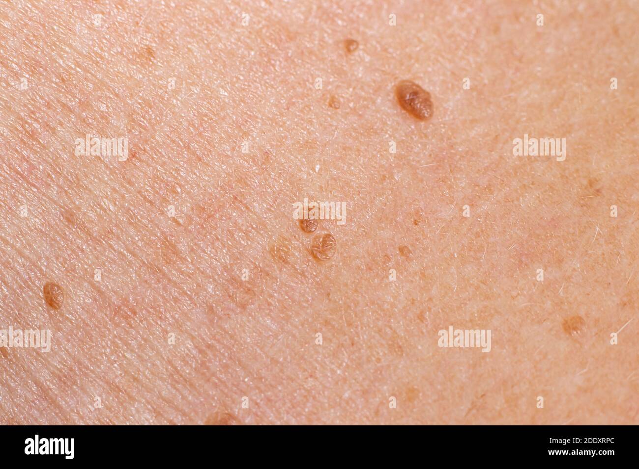 Papilloma sulla pelle umana - tumore benigno sotto forma di mole, nevo, tumore. Papillomatosi Foto Stock