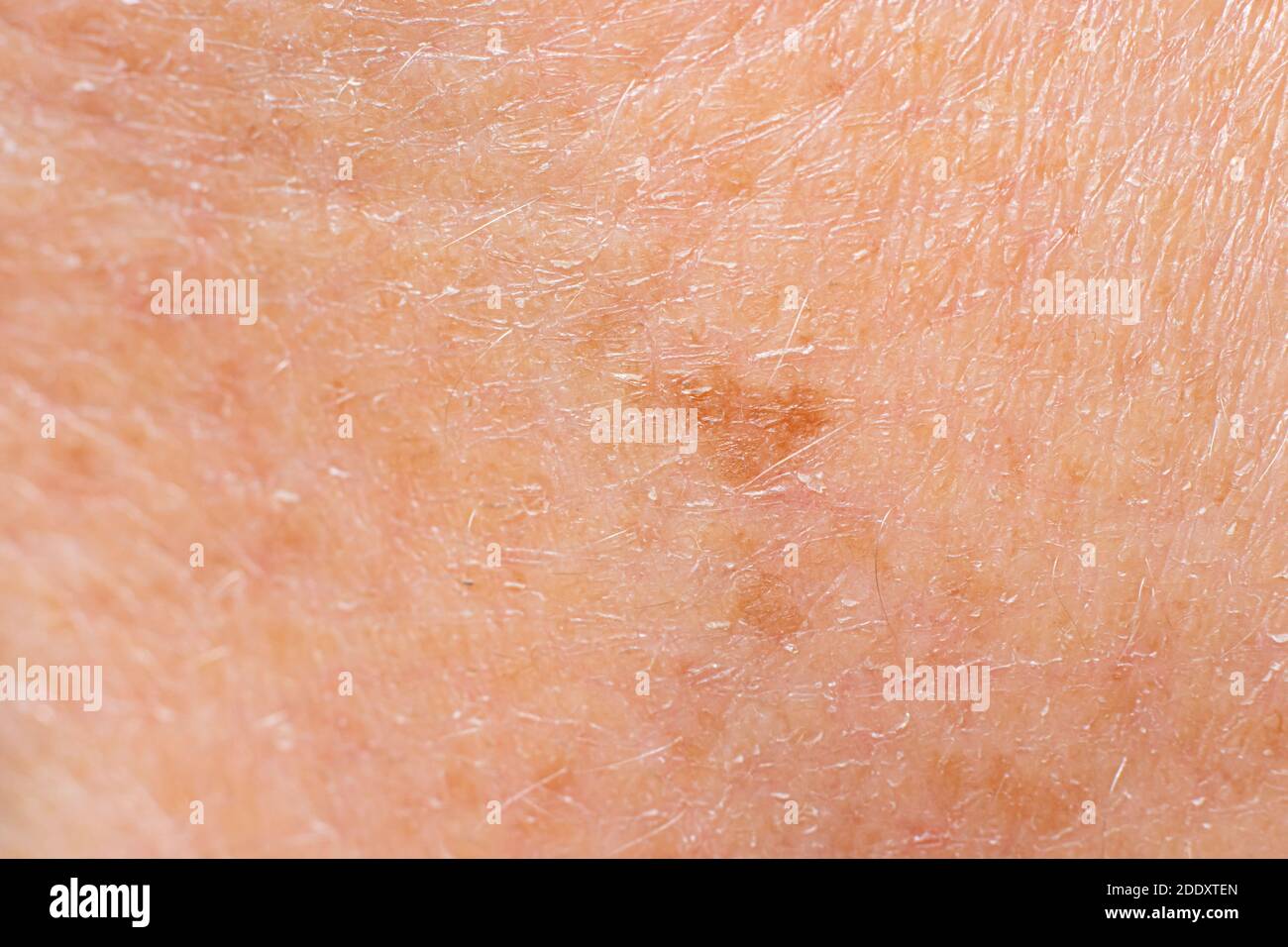 Vecchio punto di lentigo sulla pelle di una macro uomo foto. Foto Stock